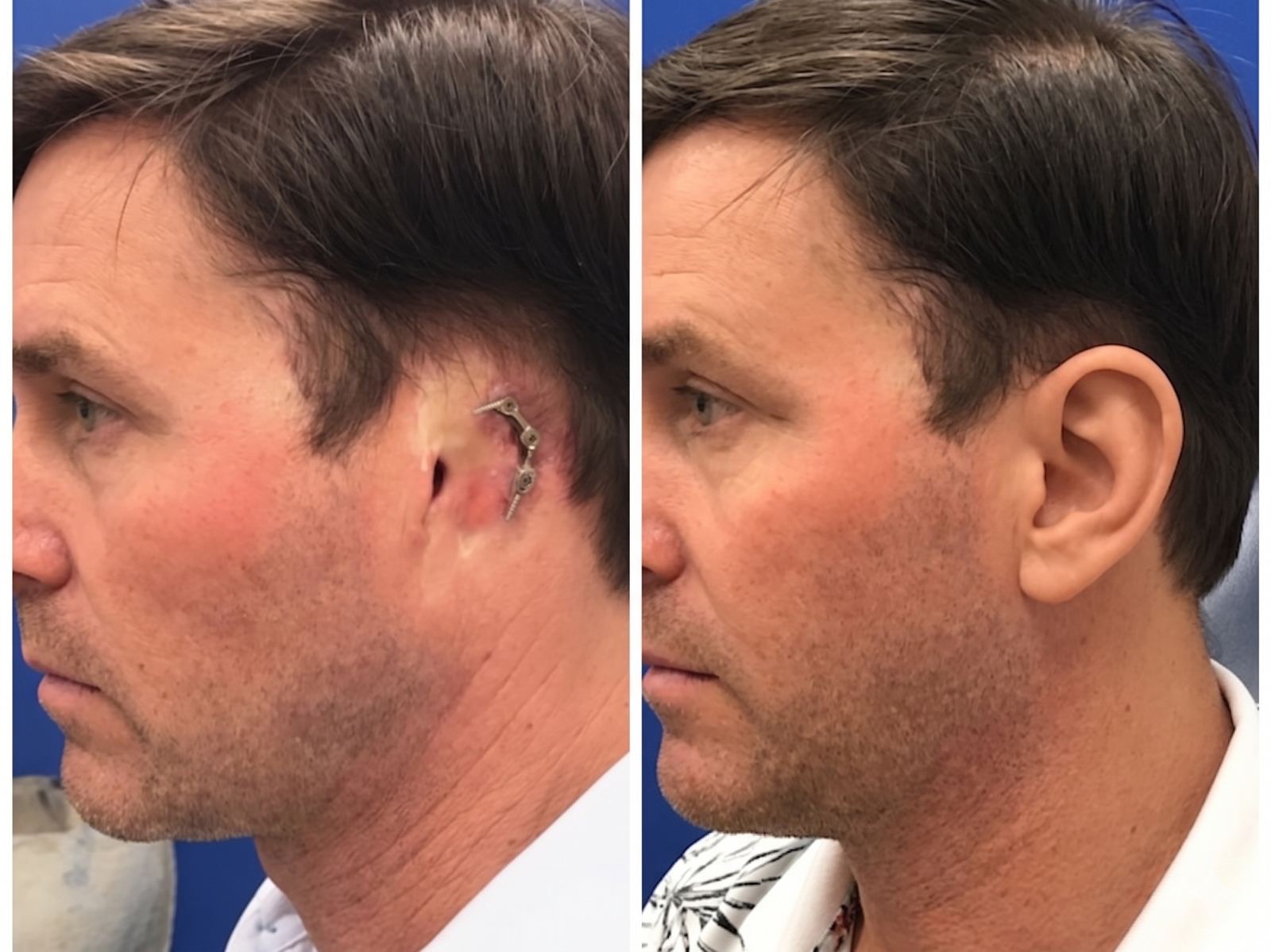 Before and after: ear prosthetic demonstrating the Disappearing Edge technique