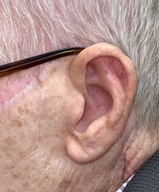 Patient after a custom ear prosthesis restoring a natural ear