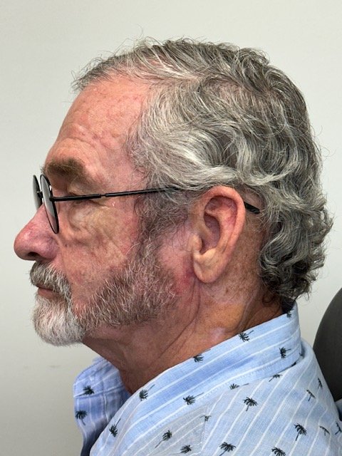 Profile of a patient after a custom ear prosthesis restoring the facial profile