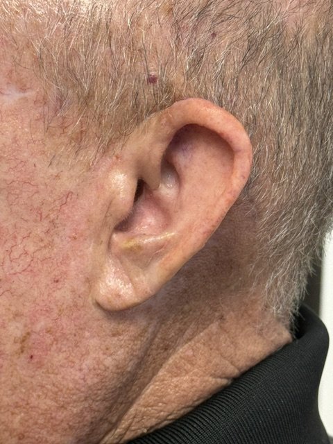 Close-up of a custom ear prosthesis blending into the surrounding skin