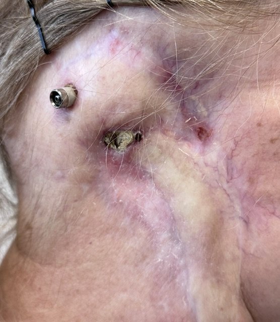 Titanium implant abutment before a custom ear prosthesis after ear loss