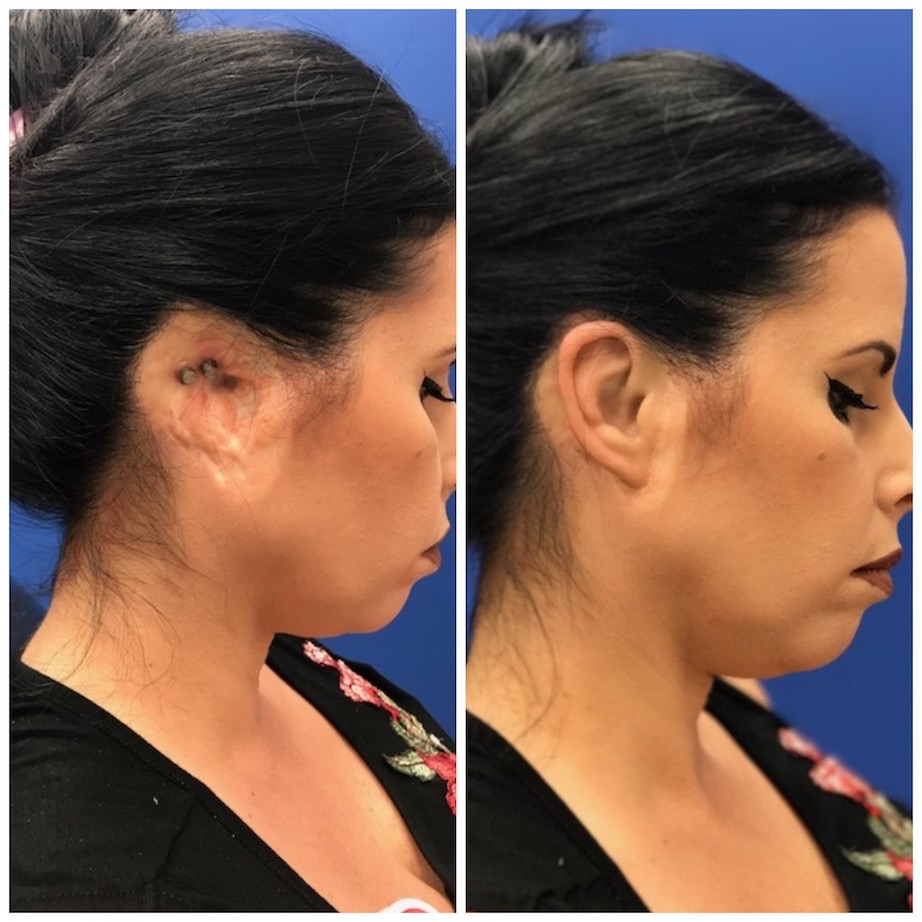 Custom ear prosthetic result