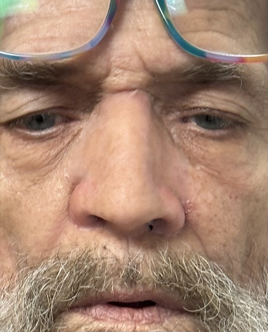 Close-up of the finished custom nasal prosthesis blending into the surrounding skin