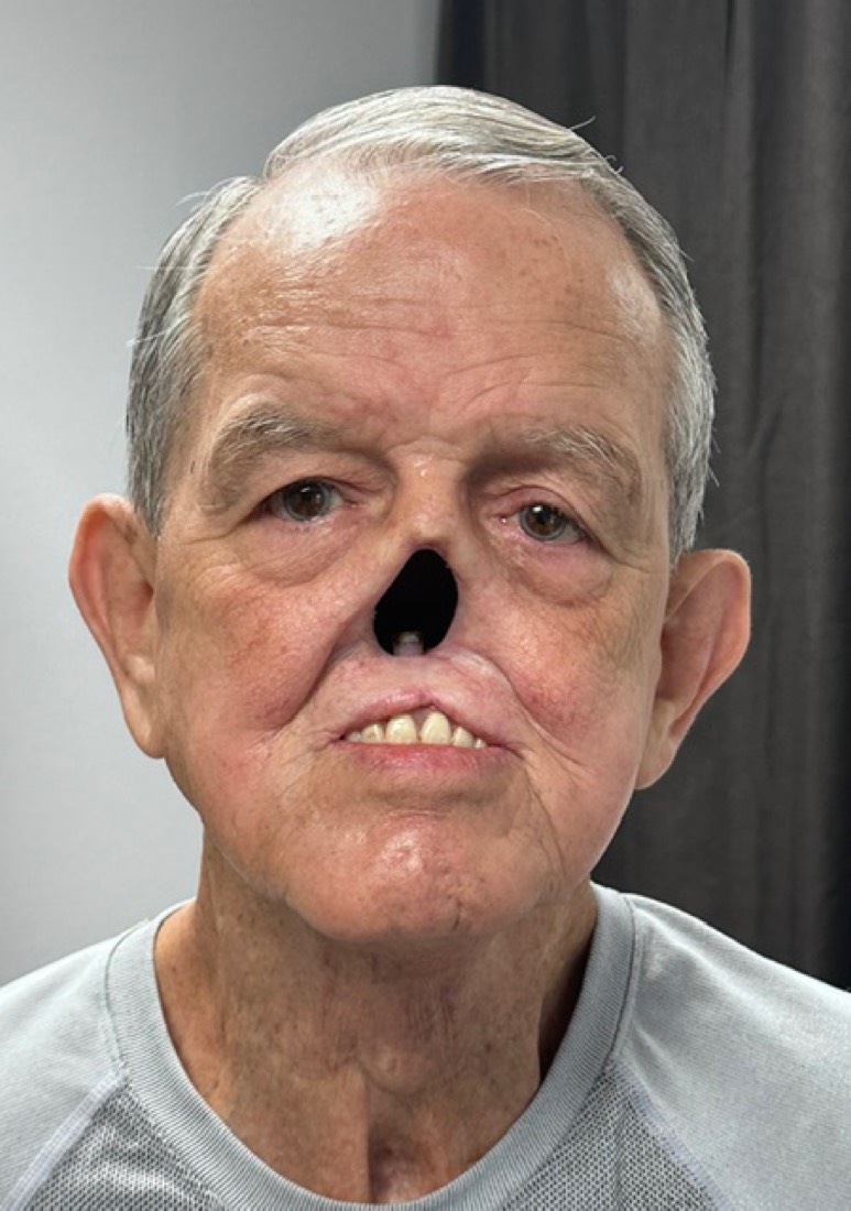 Patient with a nasal defect before a custom nasal prosthesis