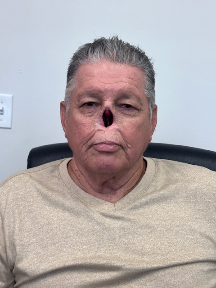 Patient with a nasal defect before a custom nasal prosthesis