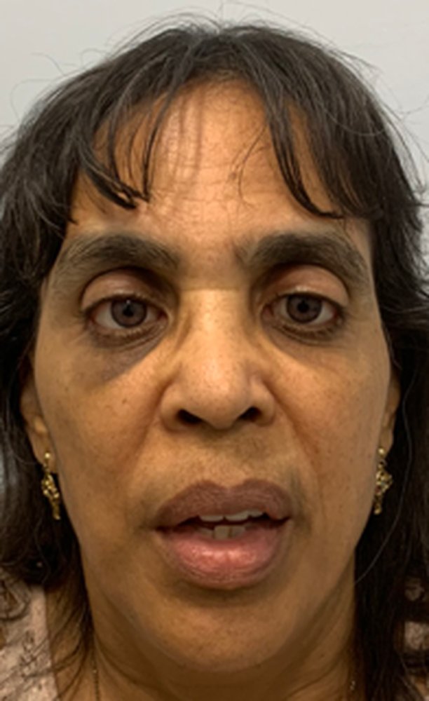 Patient after custom ocular prostheses restoring symmetry