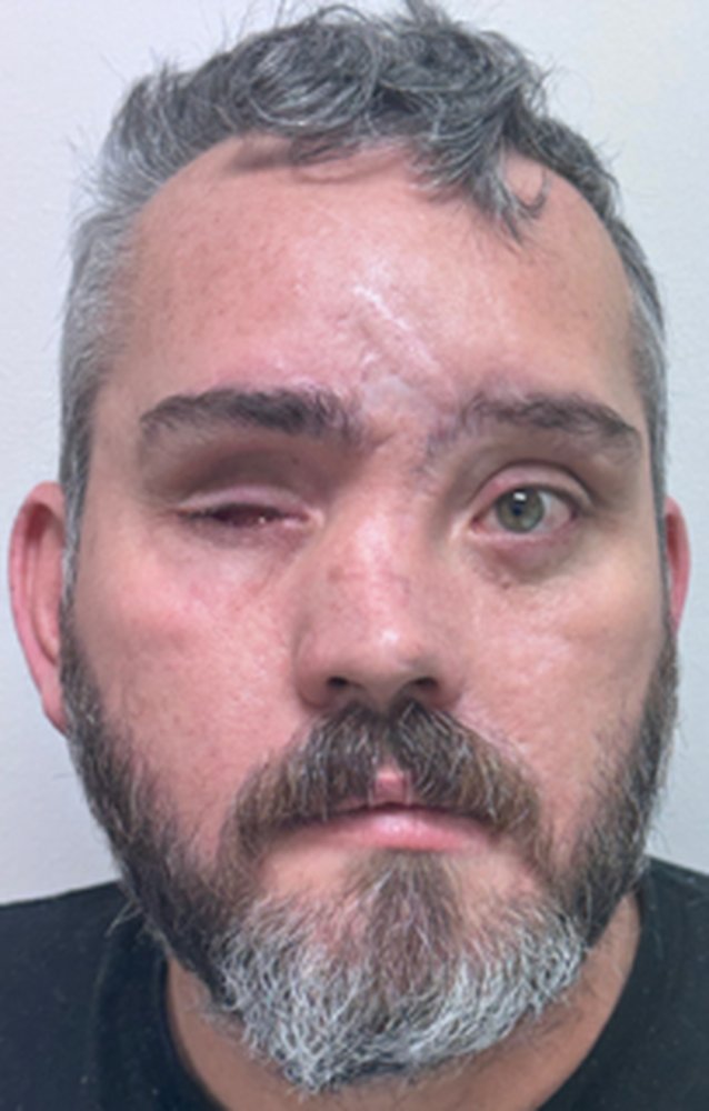 Patient before a custom ocular prosthesis