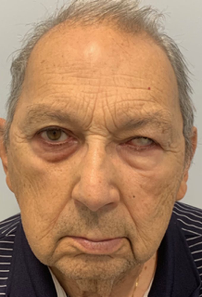 Patient before a custom ocular prosthesis