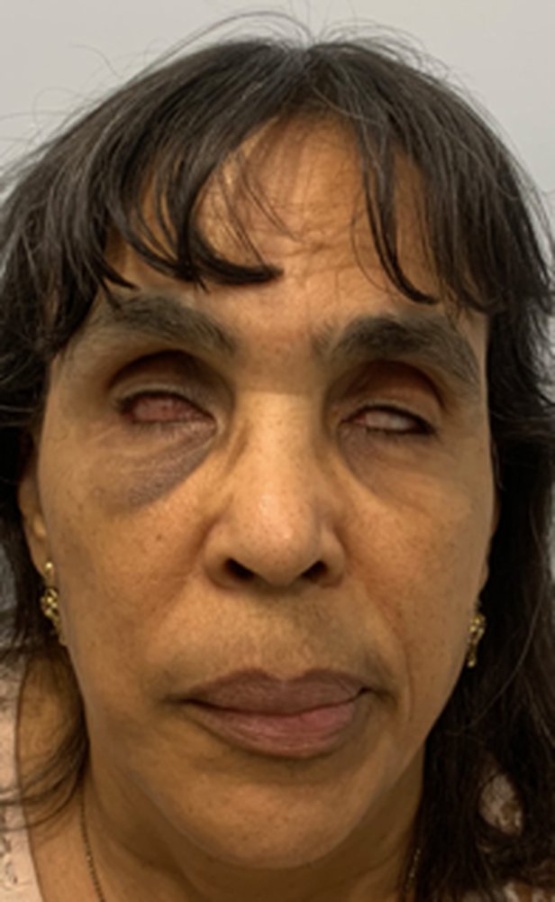 Patient before a custom ocular prosthesis