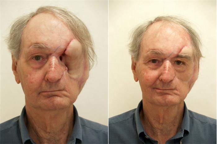 Custom orbital prosthetic result