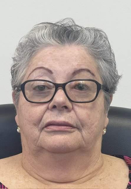 Patient after a custom orbital prosthesis restoring a natural appearance