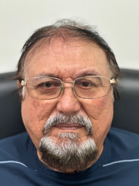 Patient after a custom orbital prosthesis restoring a natural appearance