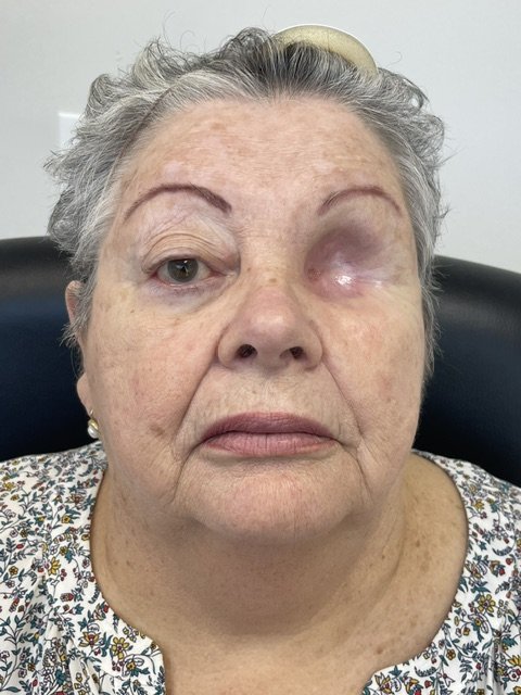 Patient with an orbital defect before a custom orbital prosthesis