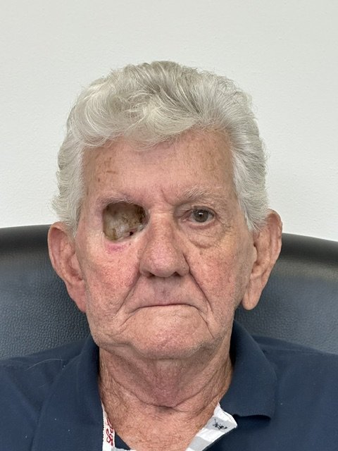Patient with an orbital defect before a custom orbital prosthesis