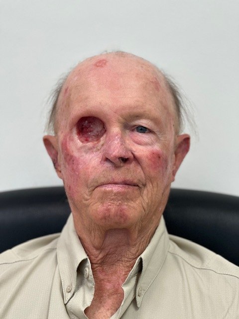 Patient with an orbital defect before a custom orbital prosthesis
