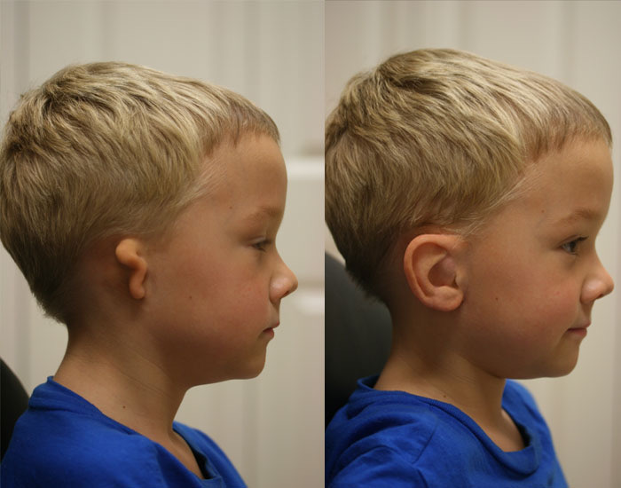 Pediatric prosthetic result
