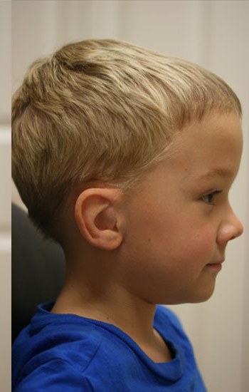 Child after a custom ear prosthesis restoring natural symmetry
