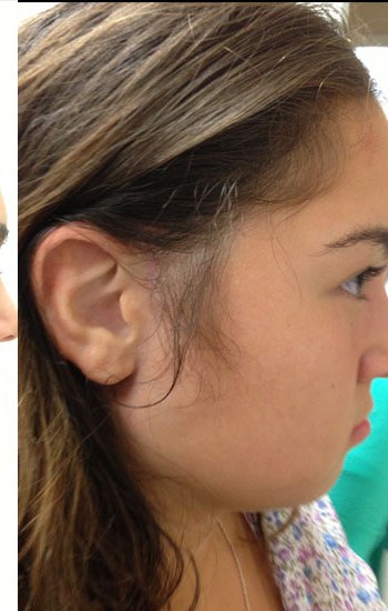 Child after a custom ear prosthesis blended to the child&rsquo;s skin and hairline