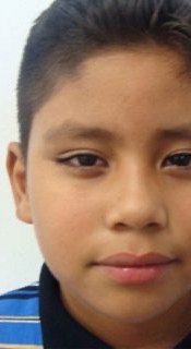 Child after a custom eye prosthesis matched to the natural eye
