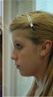 Child after a custom ear prosthesis recreating a balanced appearance