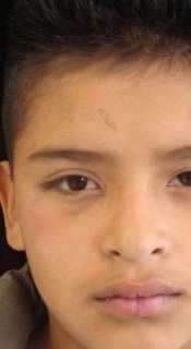Child after a custom eye prosthesis restoring facial symmetry