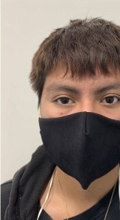 Child after a custom eye prosthesis color-matched to the natural eye