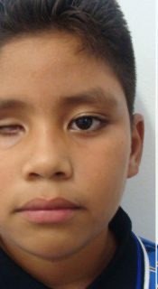 Child before a custom eye prosthesis