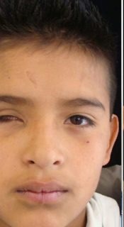 Child before a custom eye prosthesis